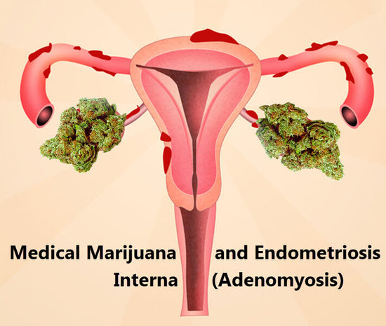 Medical Marijuana and Endometriosis Interna (Adenomyosis)